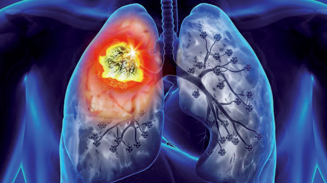 Le cancer du poumon reste le type de cancer le plus répandu en Turquie