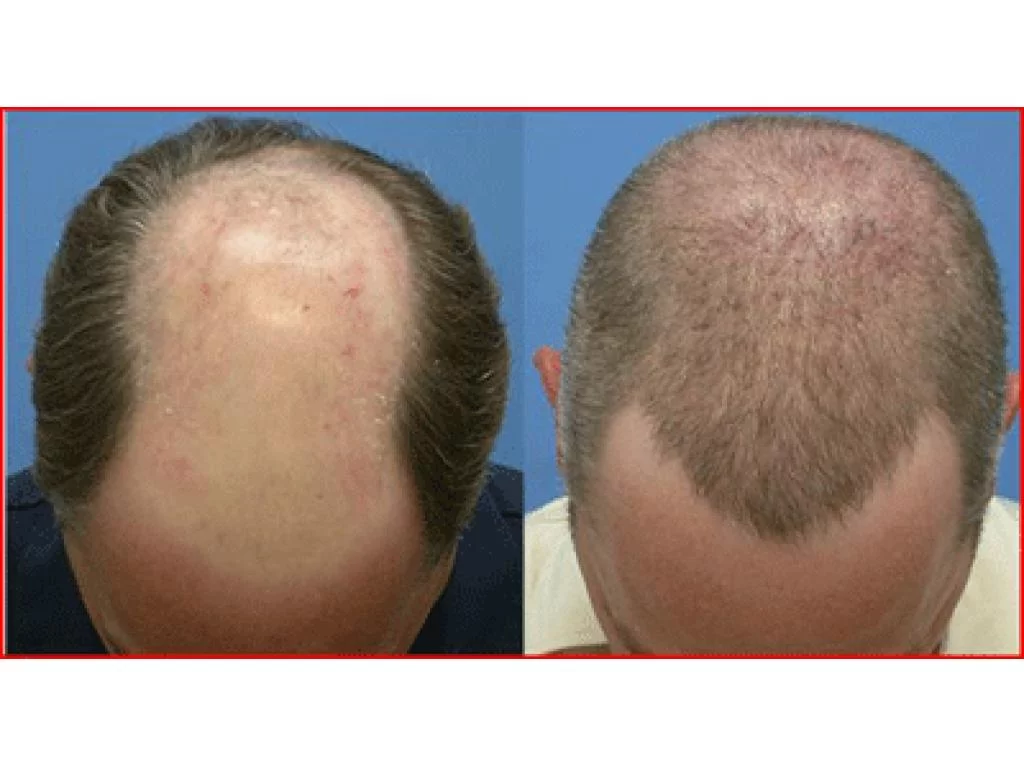 LA TURQUIE LEADER MONDIAL DES GREFFES DE CHEVEUX