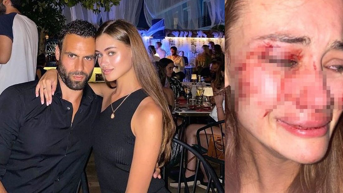 Une top-modèle assure avoir été frappée en Turquie et publie son visage gonflé d'hématomes